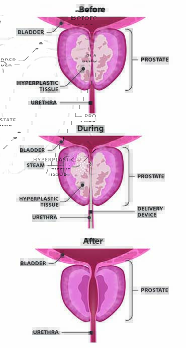 Anatomy of the male prostate before, during, and after the Rezum procedure.